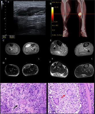 Case report: Muscular tuberculosis with lower-extremity muscular masses as the initial presentation: Clinicopathological analysis of two cases and review of the literature